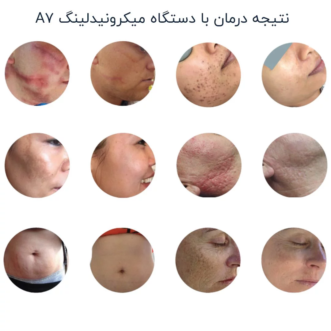 نتایج استفاده از با دستگاه میکرونیدلنگ دکتر پن A7
