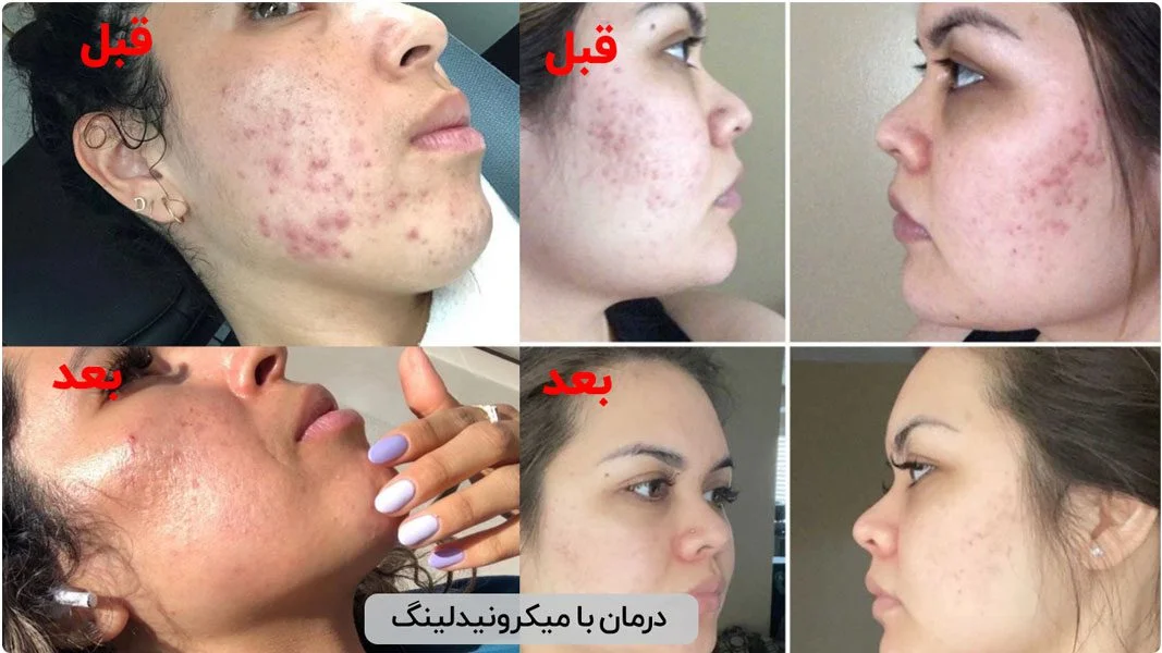 قبل و بعد از استفاده از دستگاه میکرونیدلینگ