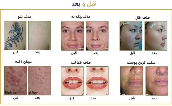 قبل و بعد از درمان با دستگاه لیزر تاتو پیکوشور