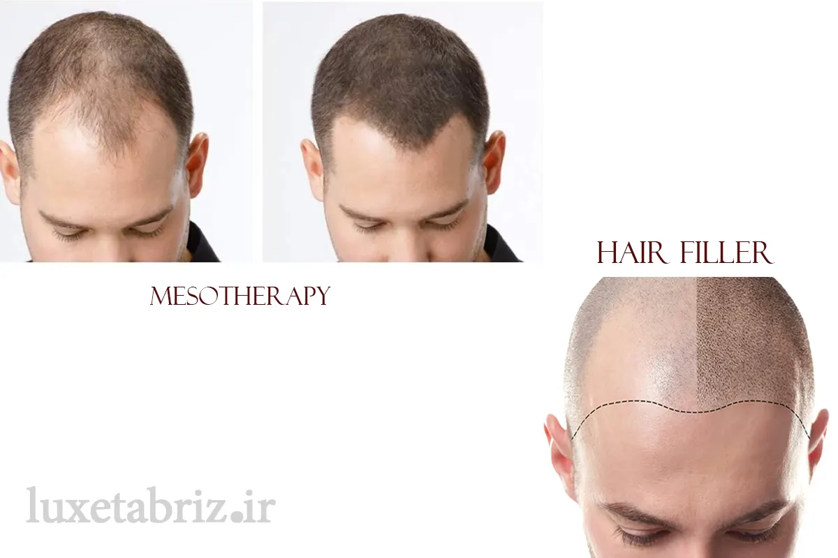 تفاوت های اصلی هیر فیلر و مزوتراپی
