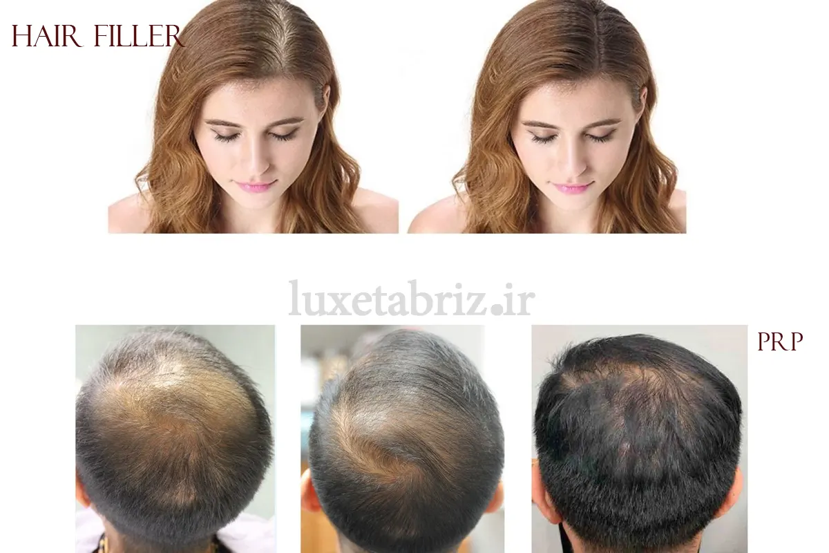 مقایسه تفاوت های هیر فیلر و پی آر پی